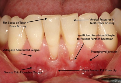 Black Spot On Lateral Teeth 37