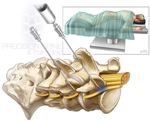 Spinal steroid injections neck pain